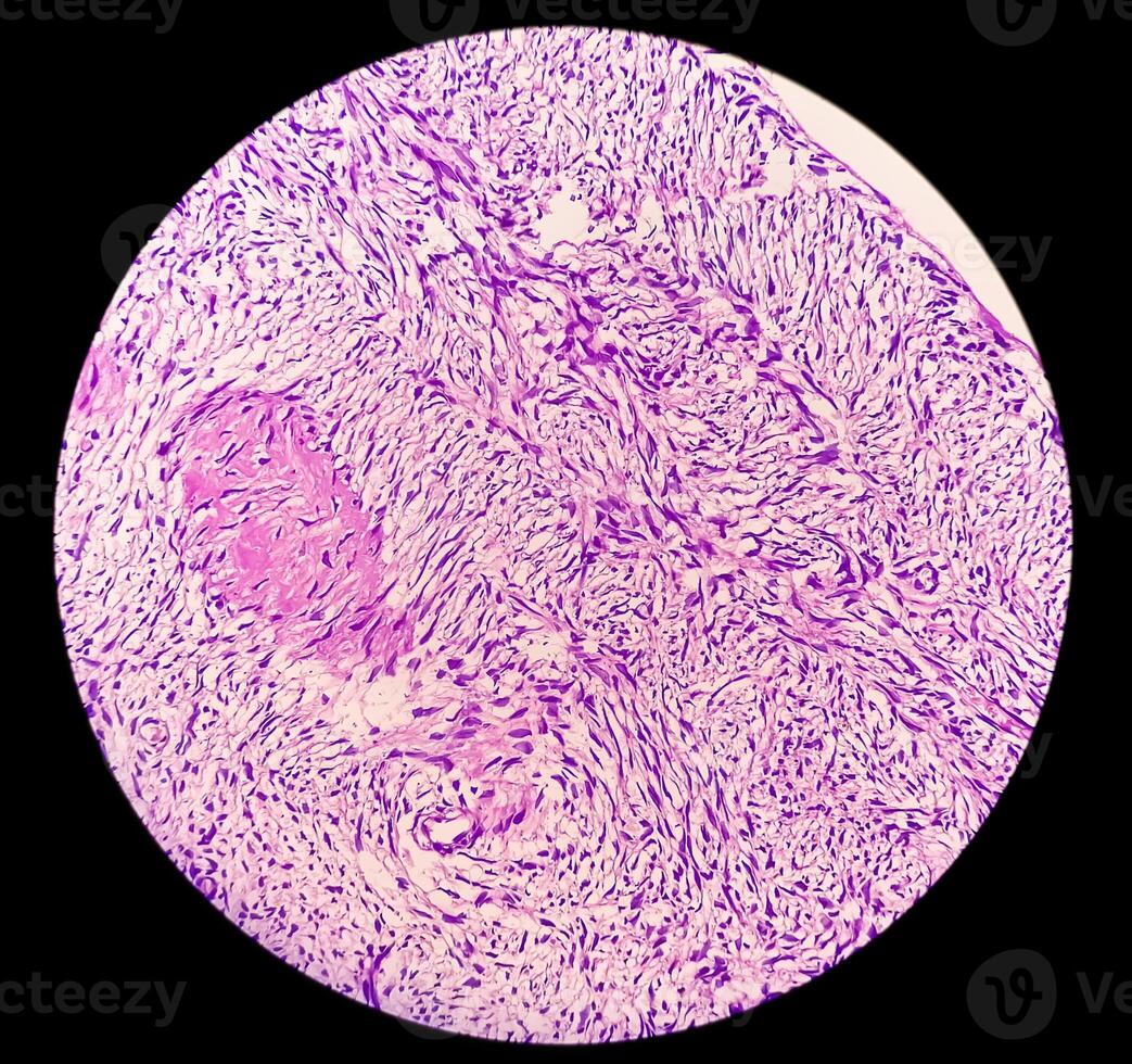 gamba fazzoletto di carta biopsia. fotomicrografico Immagine mostrando fibromixoma. superficiale acrale fibromixoma, raro lento in crescita mixoide tumore. foto