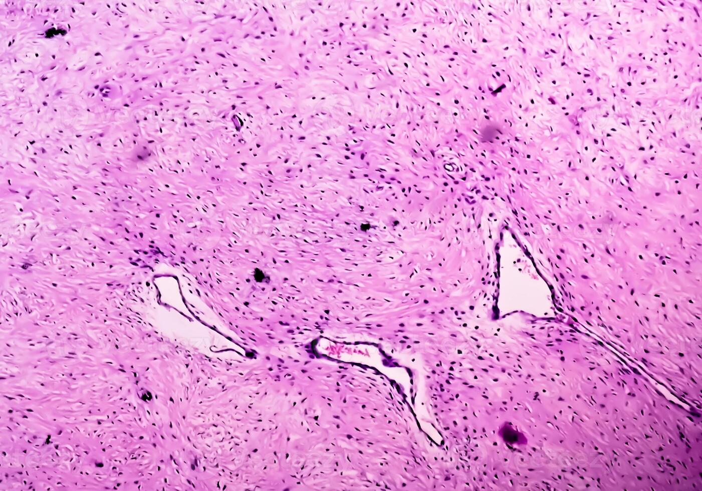 gamba fazzoletto di carta biopsia. fotomicrografico Immagine mostrando fibromixoma. superficiale acrale fibromixoma, raro lento in crescita mixoide tumore. foto