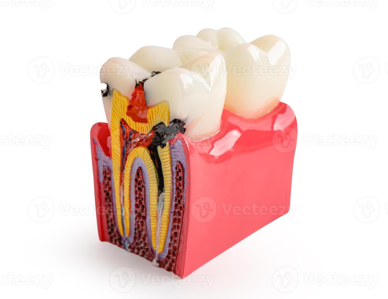 dente decadimento, dentale impiantare, artificiale dente radici in mascella, radice canale, gomma patologia, denti modello isolato su bianca sfondo con ritaglio sentiero. foto