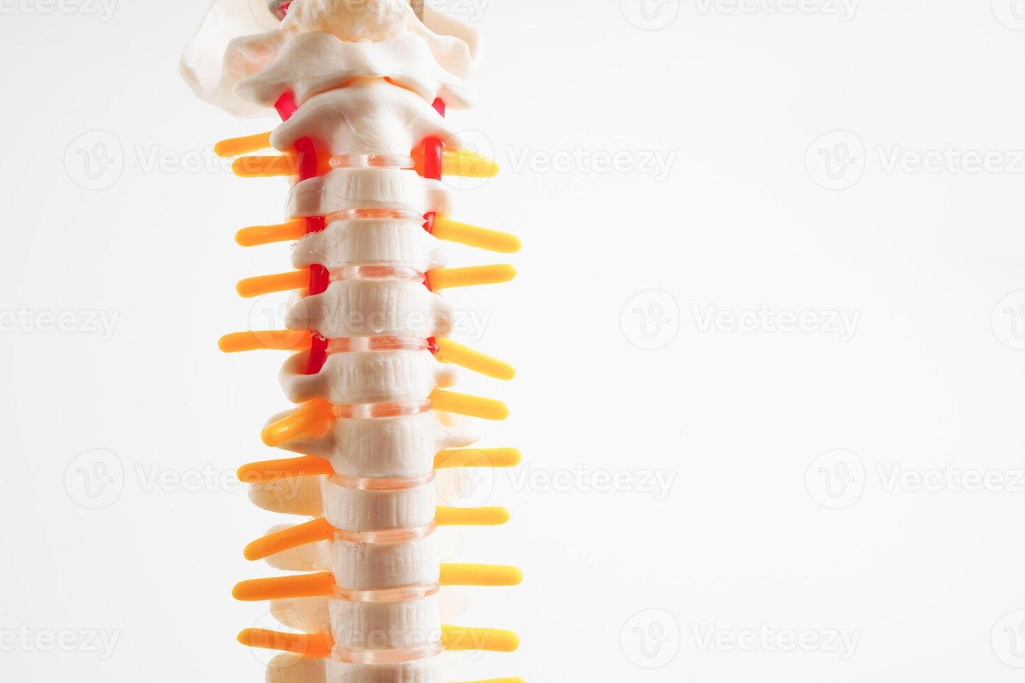 spinale nervo e osso, lombare colonna vertebrale sfollati ernia disco frammento, modello per trattamento medico nel il ortopedico Dipartimento. foto