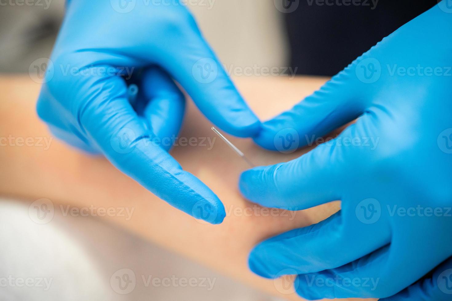 mani del fisioterapista che fanno un dry needling foto