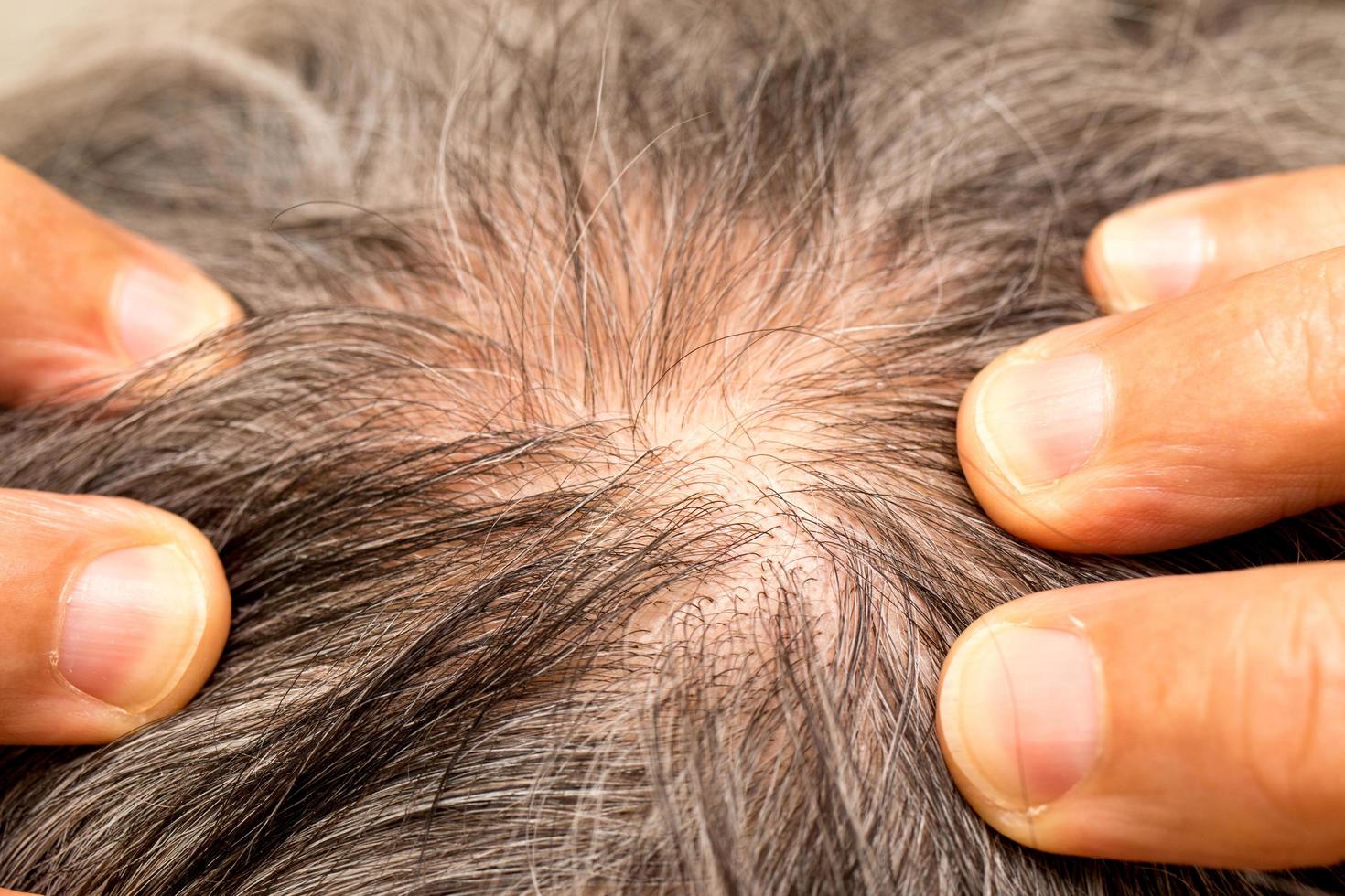 uomo anziano con i capelli radi sulla parte posteriore della testa intorno alla corona foto