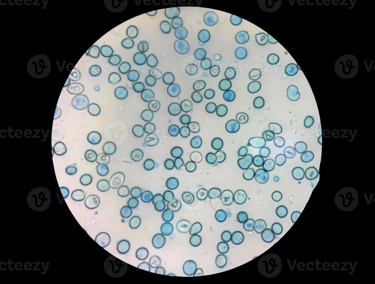 vista microscopica ravvicinata del conteggio anomalo dei reticolociti nel reparto di ematologia, colorazione con blu di metilene foto