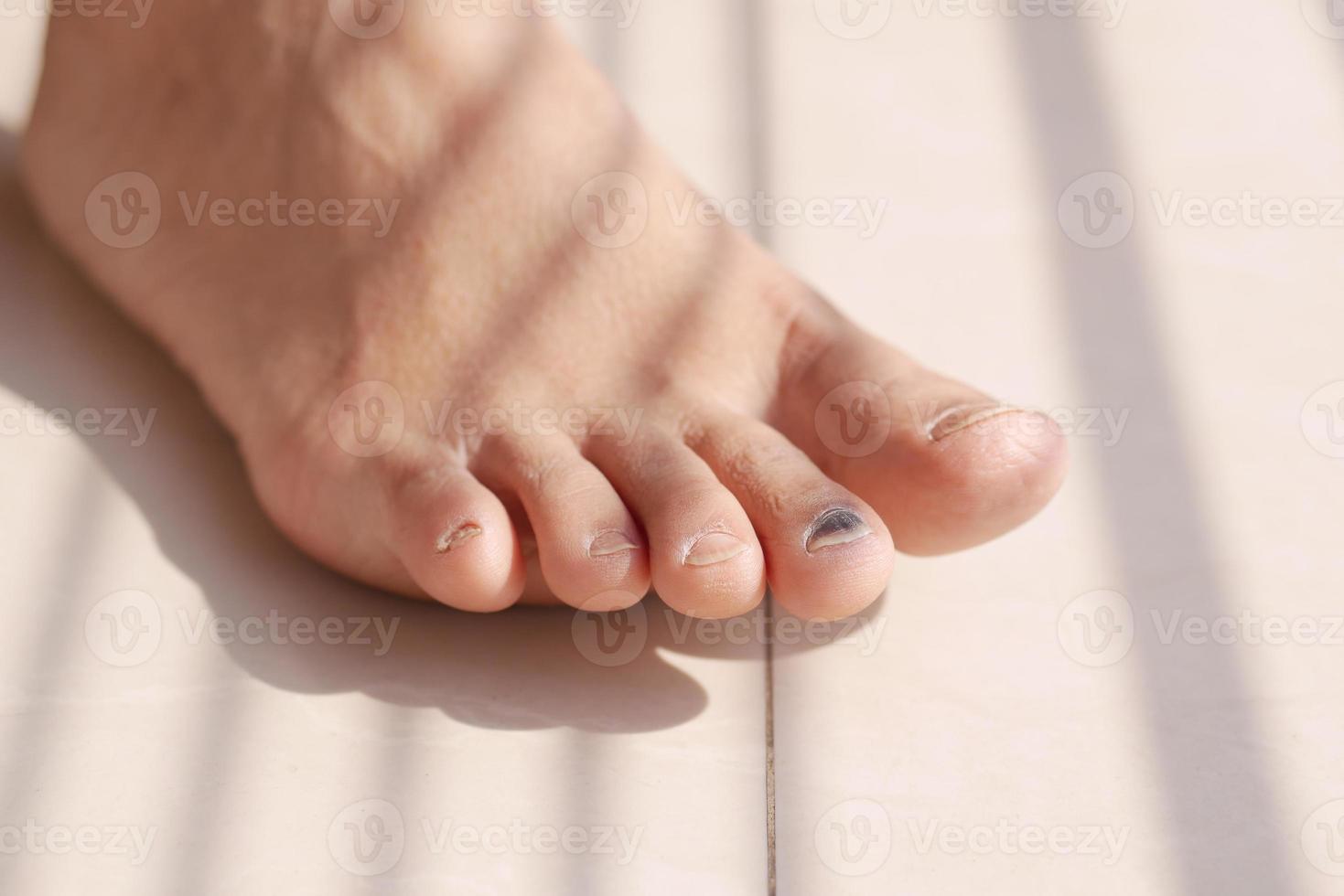 primo piano delle dita dei piedi infetti delle donne sul letto, foto