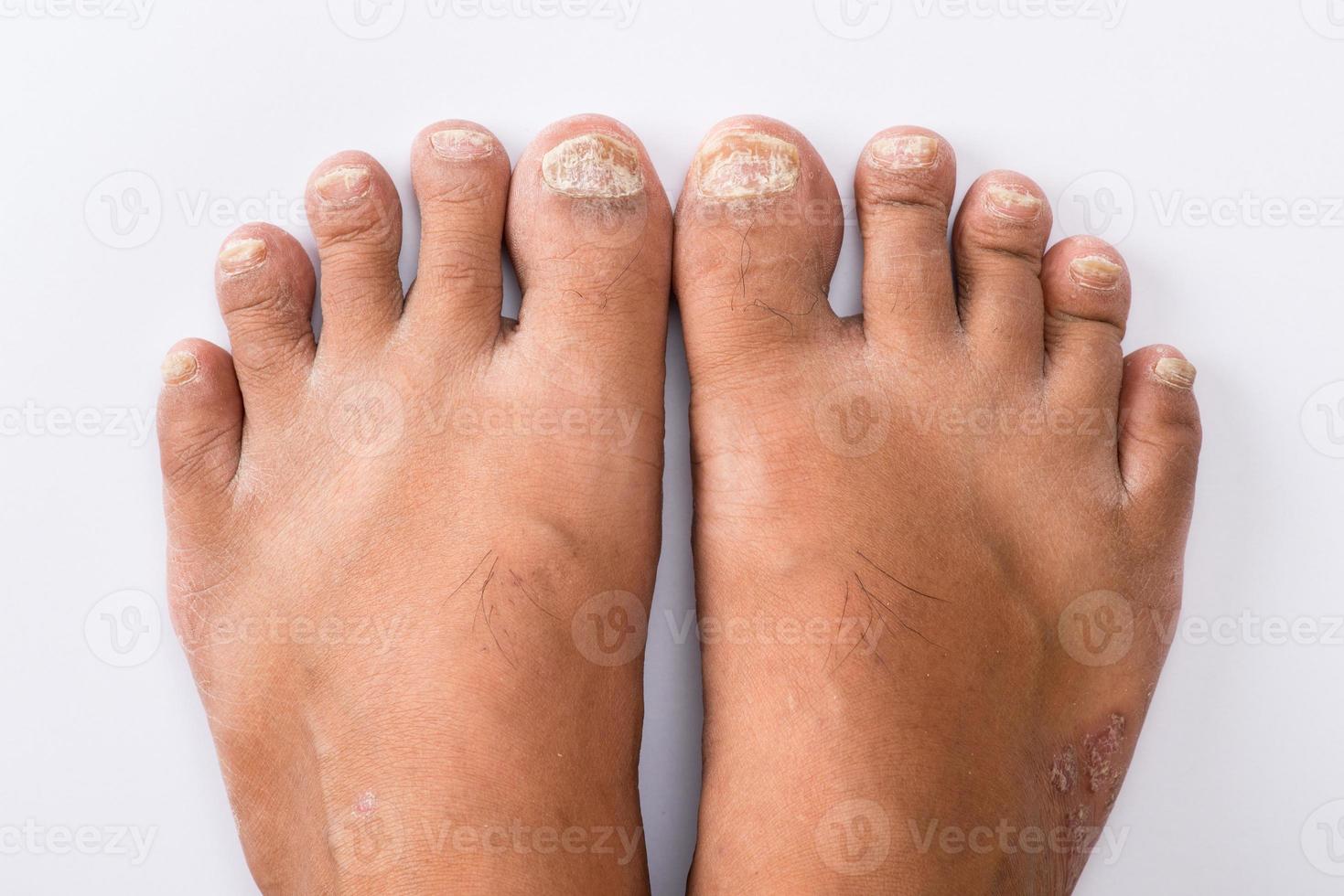 psoriasi che pedicure su sfondo bianco foto