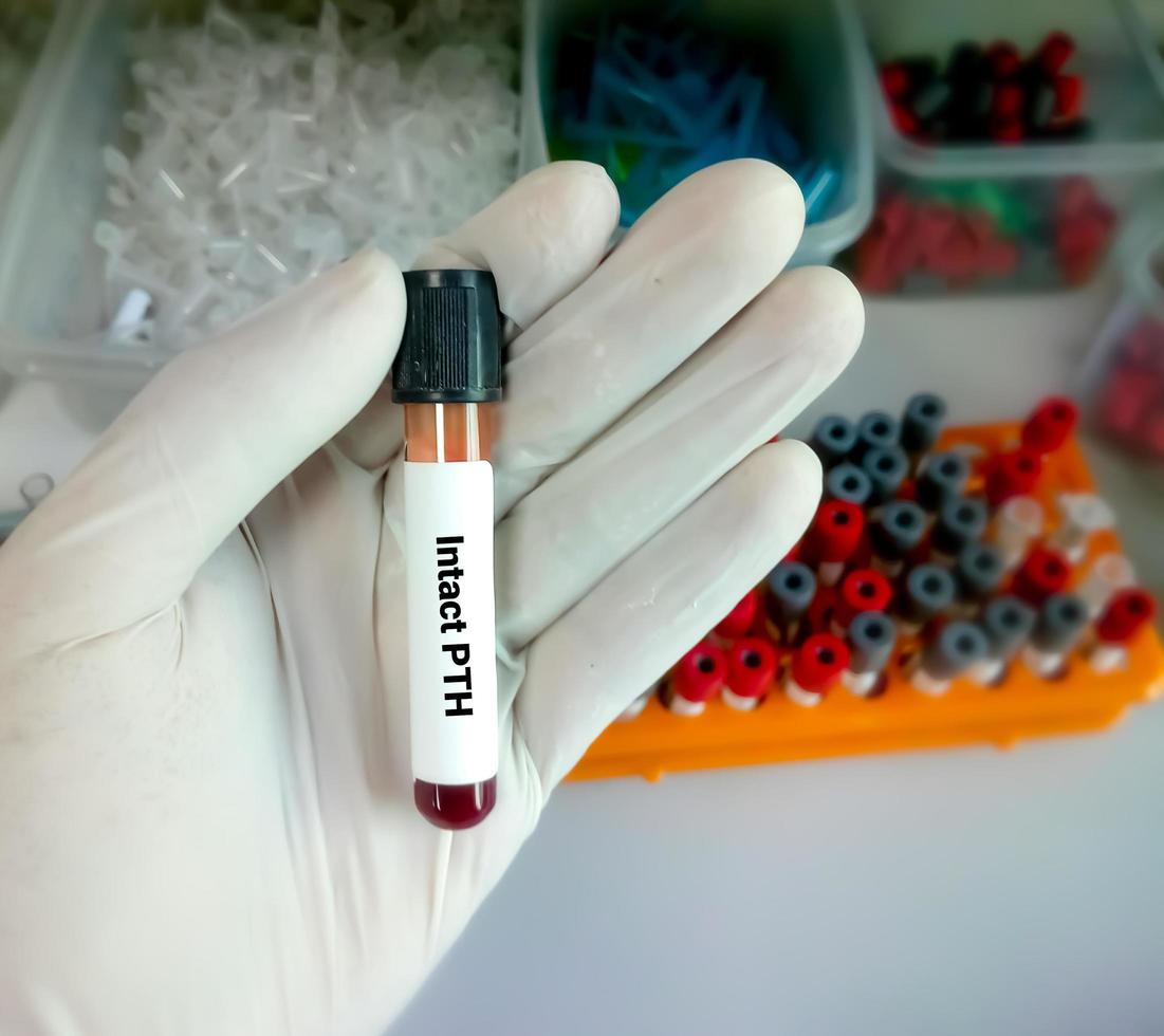 lo scienziato o il biochimico tengono un campione di sangue per il test pth o ipth intatto, l'ormone paratiroideo. foto