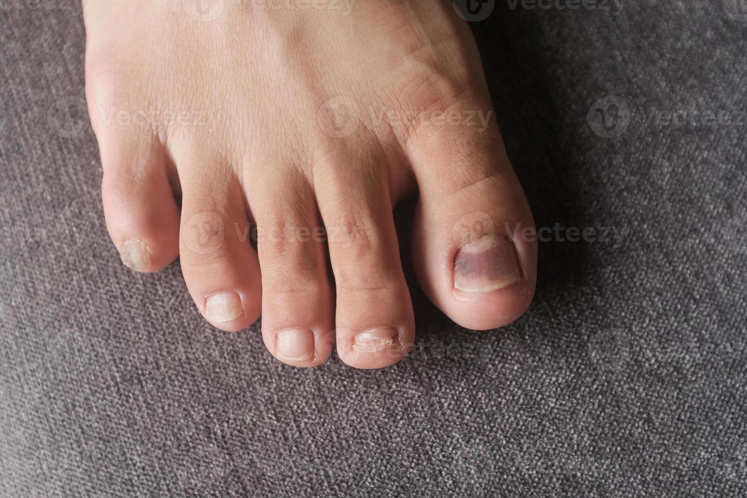 vista ravvicinata di un'unghia del piede con scolorimento viola a causa di un infortunio foto
