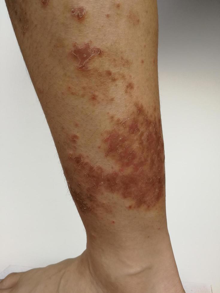 il ragazzo ha un'eruzione cutanea cronica sulla pelle. malattia della pelle allergica all'erba. dermatite atopica. pelle macchiata dell'età foto