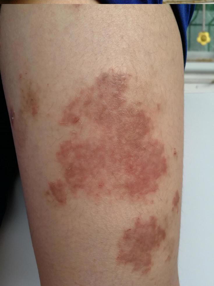 il ragazzo ha un'eruzione cutanea cronica sulla pelle. malattia della pelle allergica all'erba. dermatite atopica. pelle macchiata dell'età foto