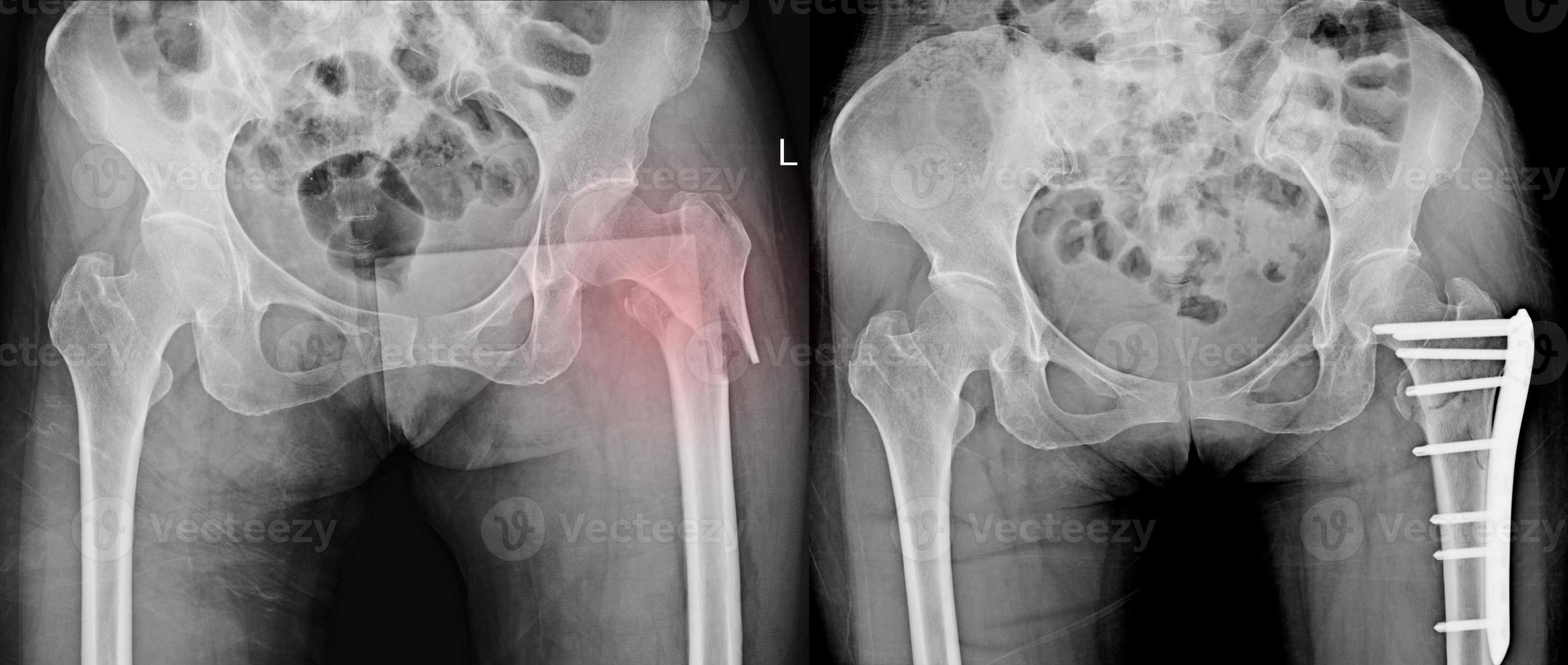 frattura guarita collo femore sinistro post fix con placca e viti.nessuna lussazione, distruzione ossea.normale spazio articolare.nessun versamento articolare. foto