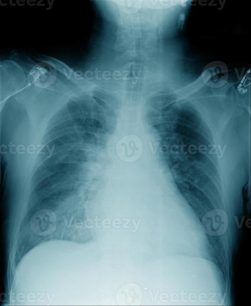 immagine radiografica del torace in tonalità blu foto