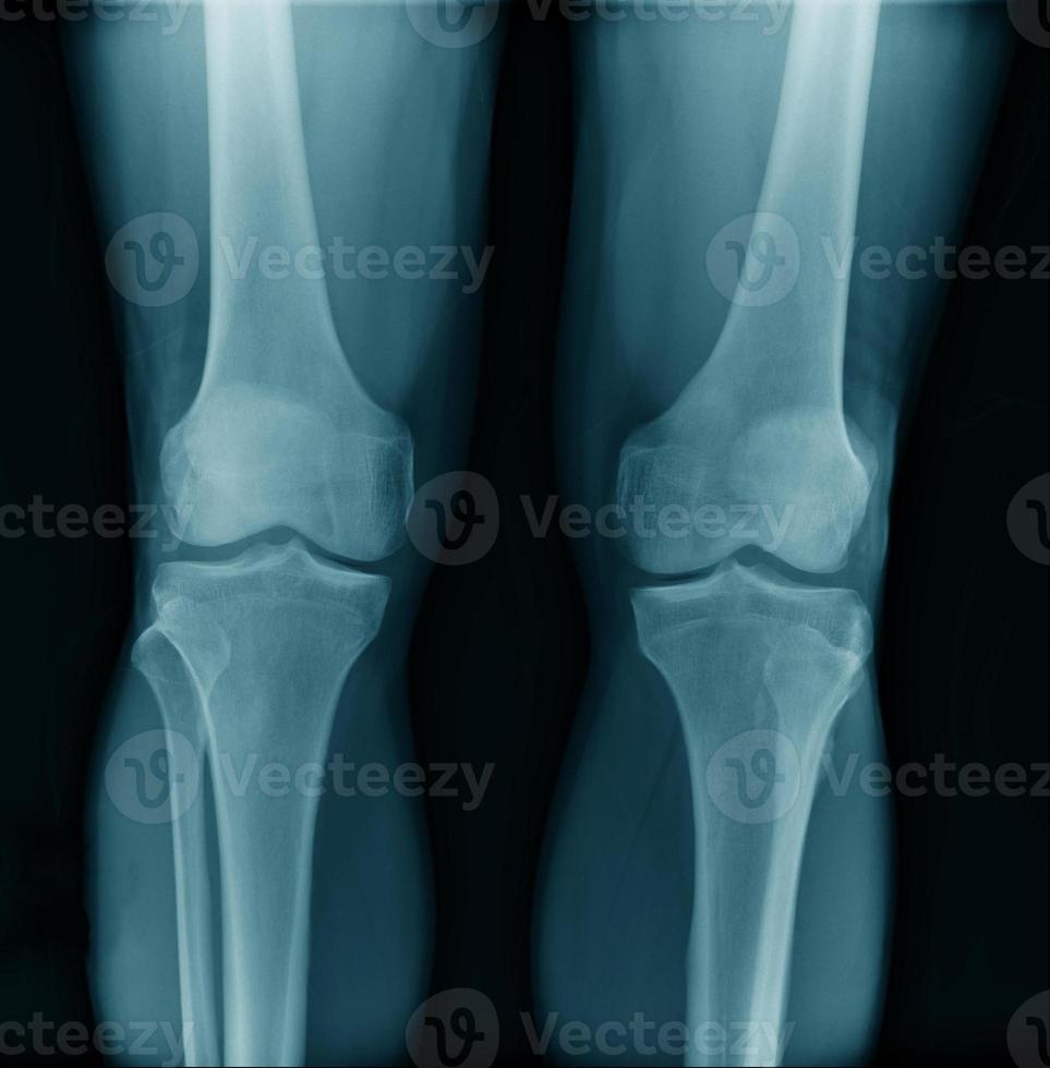oa immagine a raggi X del ginocchio vista posteo-anteriore foto