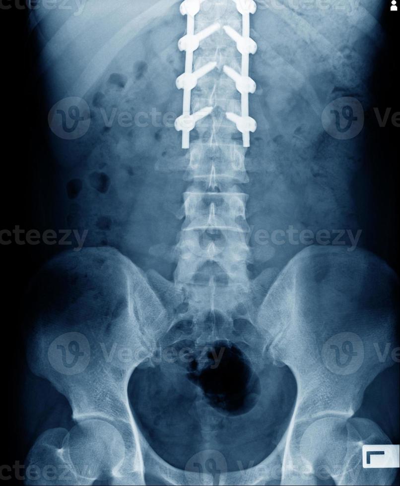 vista anteriore della struttura ossea con fissazione interna foto