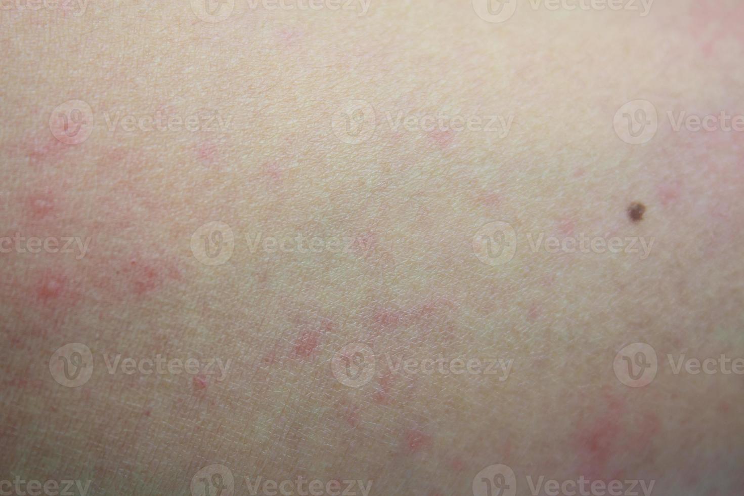 malata eruzione cutanea allergica dermatite eczema pelle del paziente foto