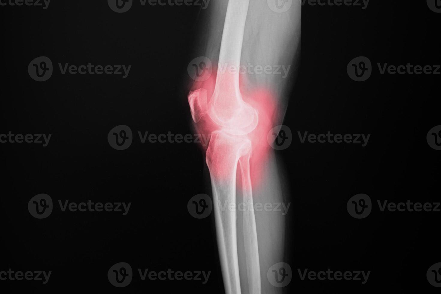 ginocchio a raggi x del film del paziente del ginocchio di osteoartrite e dell'articolazione artificiale foto