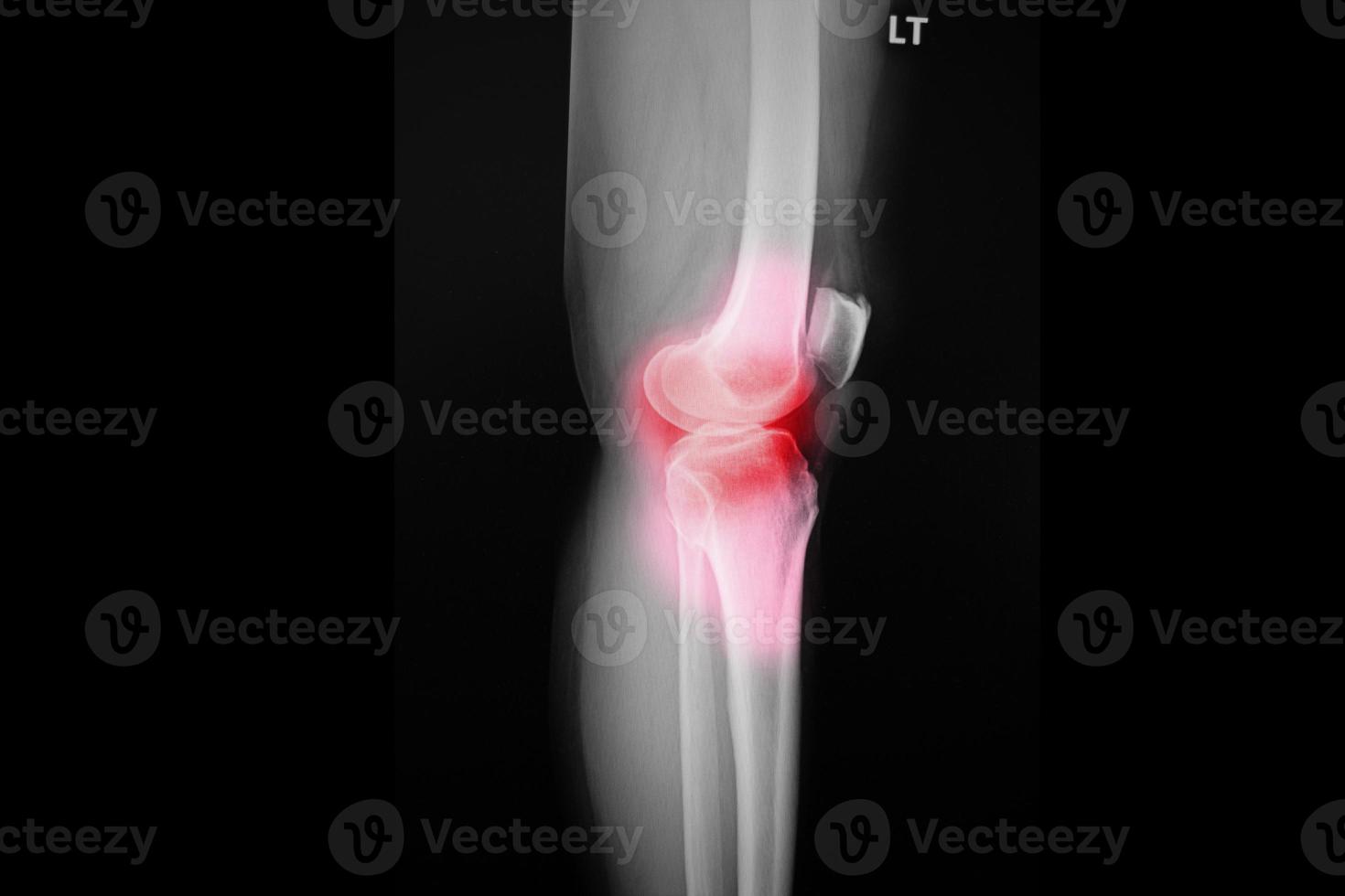 ginocchio a raggi x del film del paziente del ginocchio di osteoartrite e dell'articolazione artificiale foto