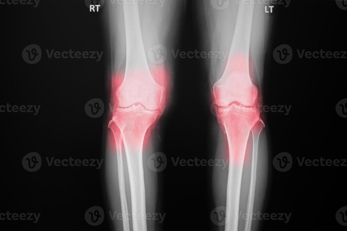 film x-ray sia il ginocchio del paziente con osteoartrite al ginocchio che l'articolazione artificiale foto