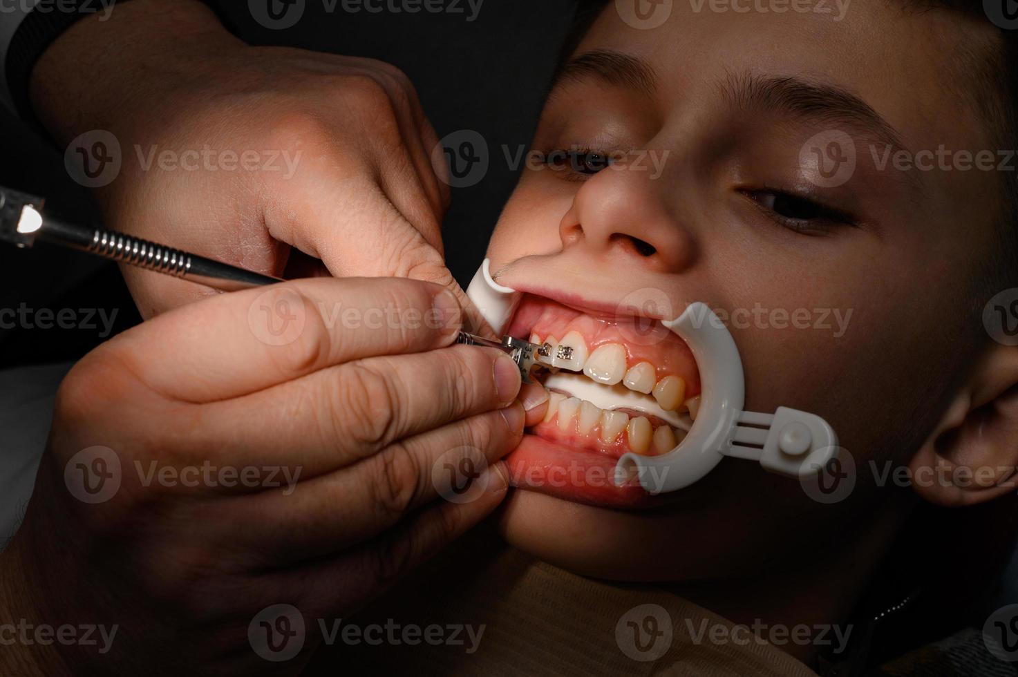 l'ortodontista installa apparecchi ortodontici per il fidanzato dello studente, visite dal dentista, installazione di apparecchi ortodontici, divaricatore sulle labbra del paziente. foto