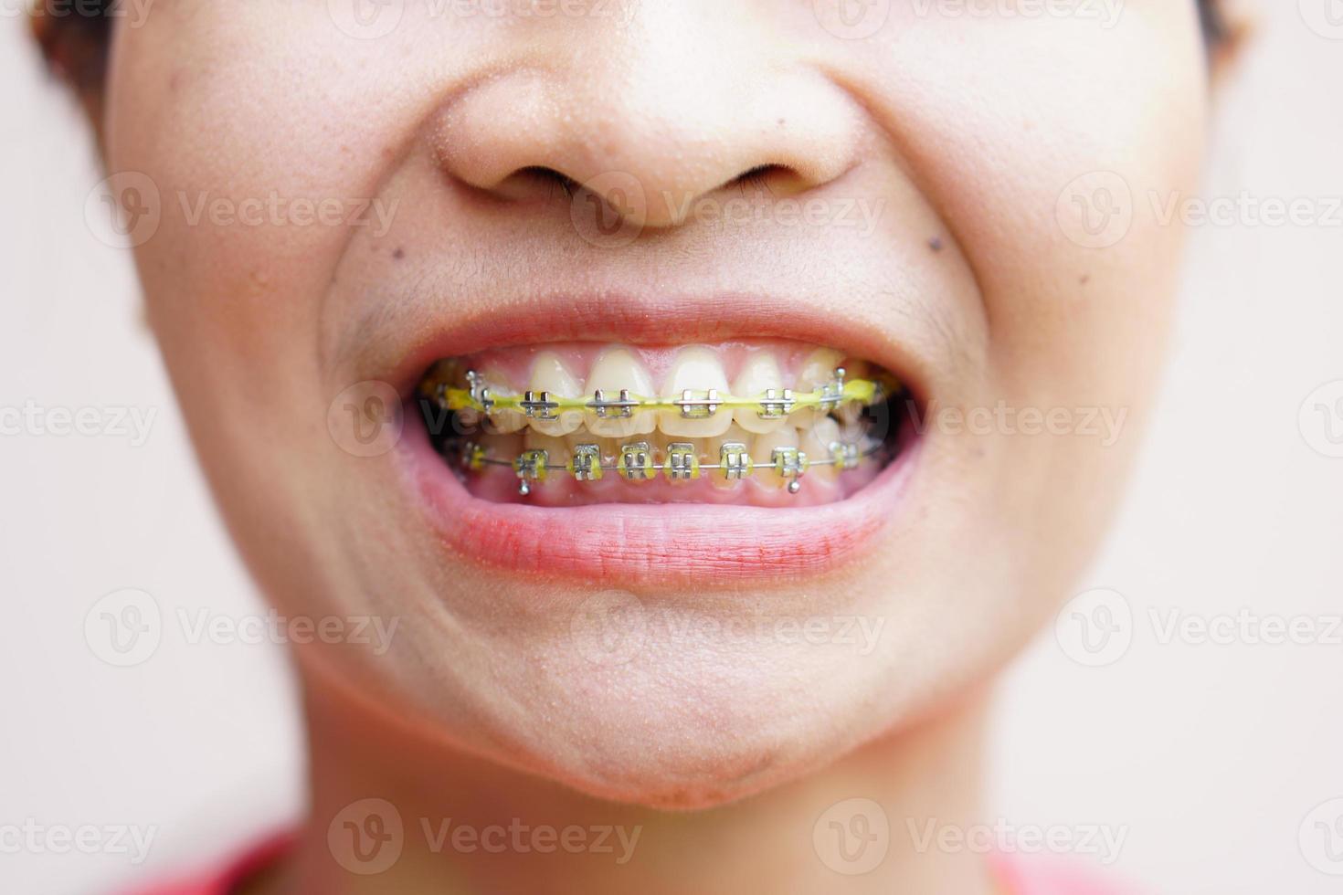 la donna asiatica sorridente ha le parentesi graffe foto