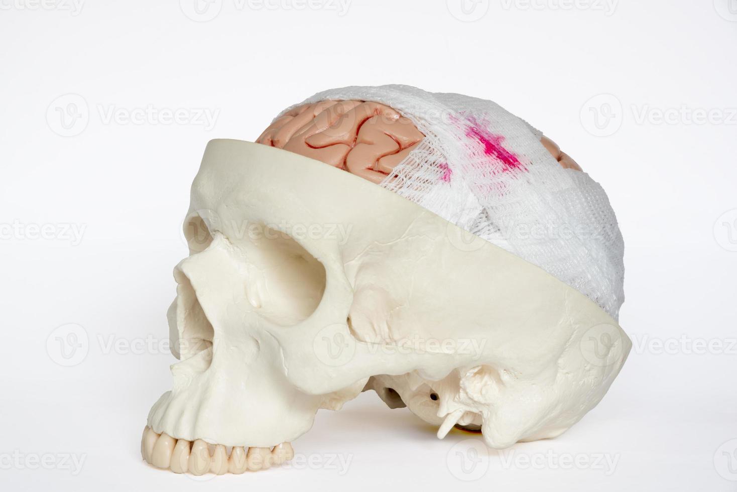 modello di lesione cerebrale vista obliqua su sfondo bianco foto