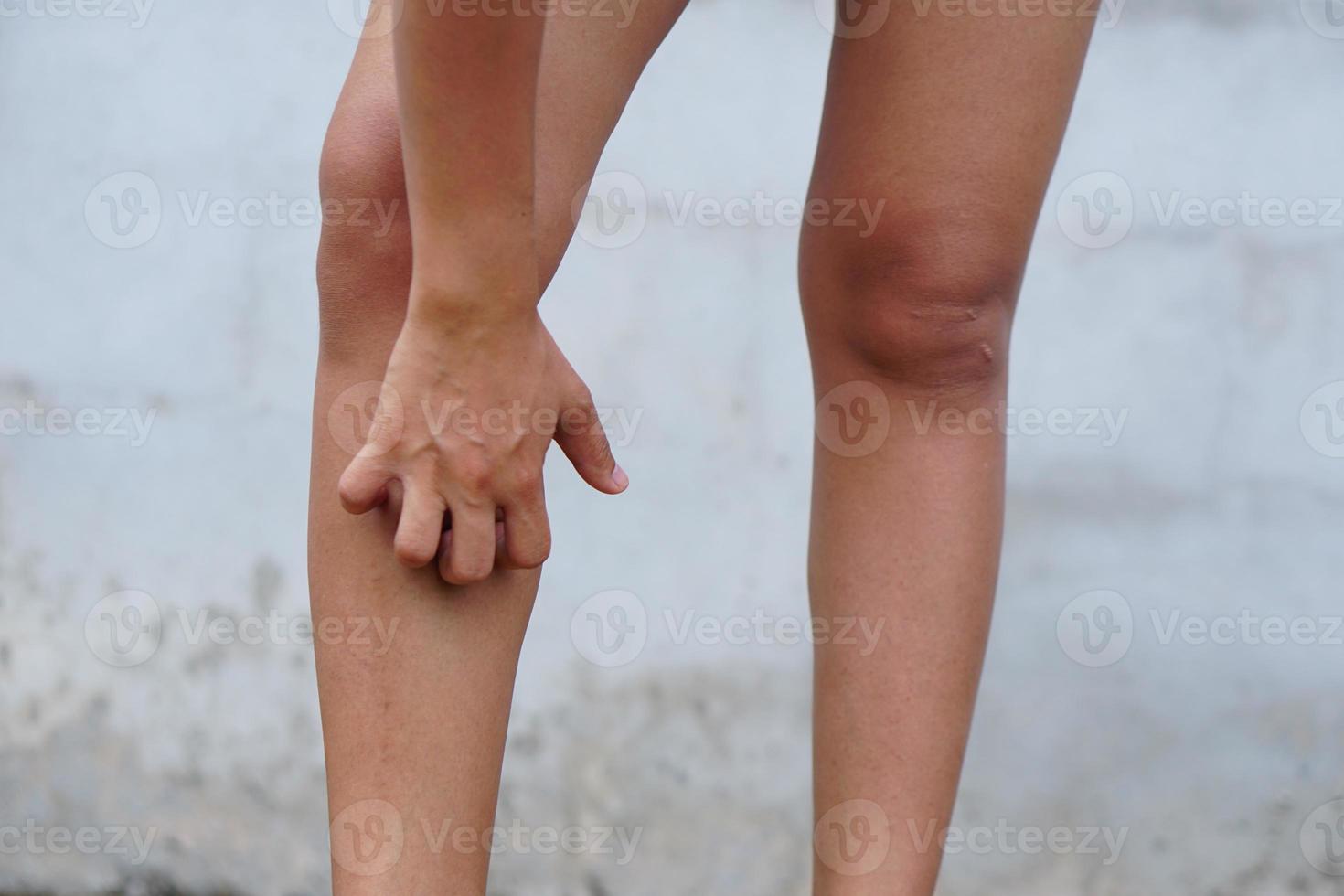 donna che indossa pantaloncini gambe pruriginose graffiare con le mani per alleviare il prurito. foto