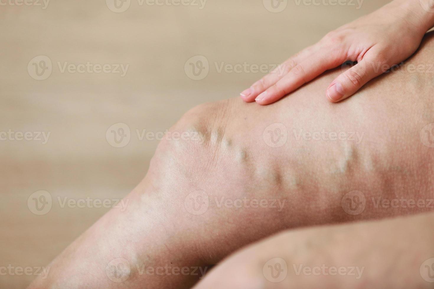 dolorose varici e vene varicose sulle gambe della donna attiva, auto-aiuto nel superare il dolore. malattie vascolari, problemi di vene varicose, concetto di vita attiva. foto