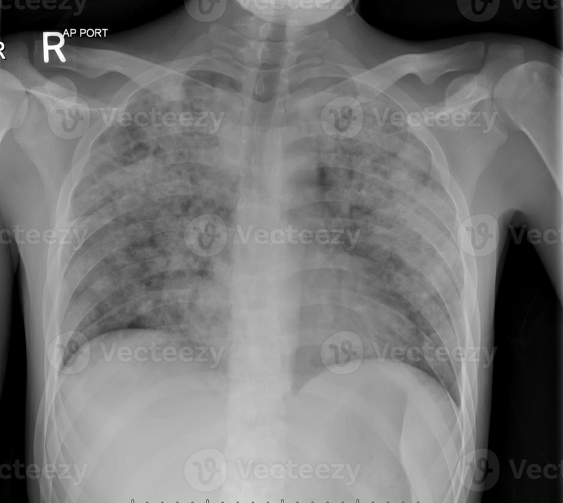 radiografia del torace in un paziente con tubercolosi polmonare attiva che mostra polmonite e cavitazione diffusa in entrambi i polmoni. foto