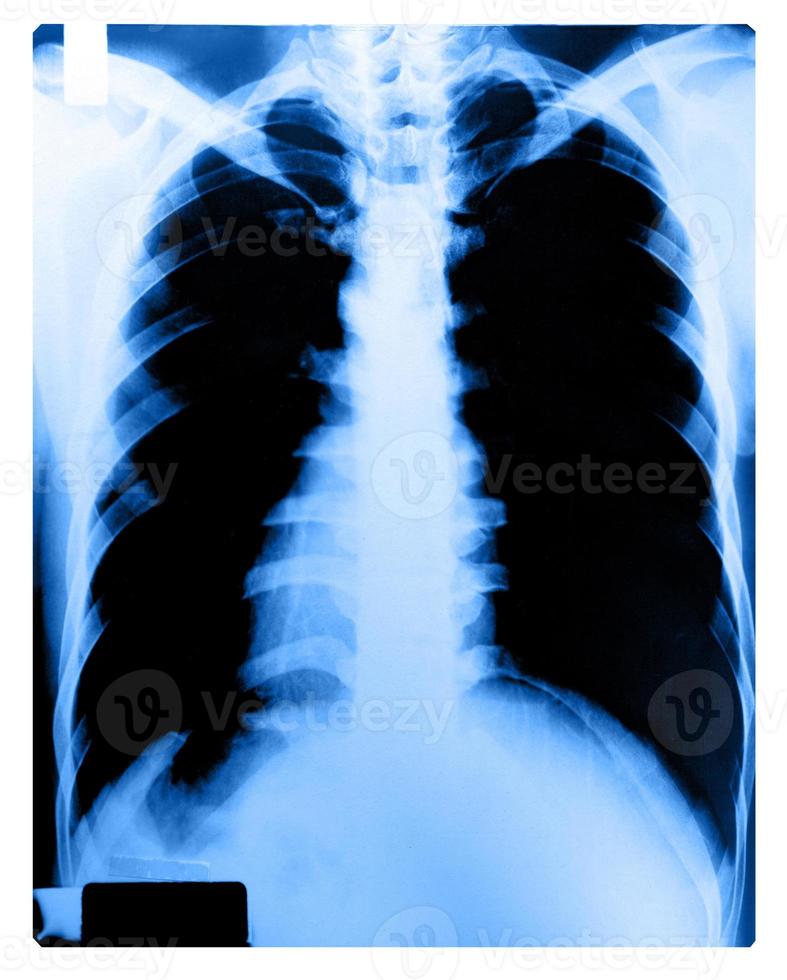 immagine a raggi x del torace umano foto