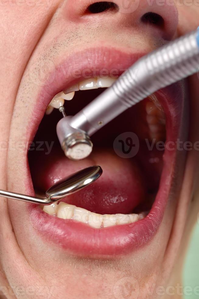 il dentista fa il processo di trattamento foto