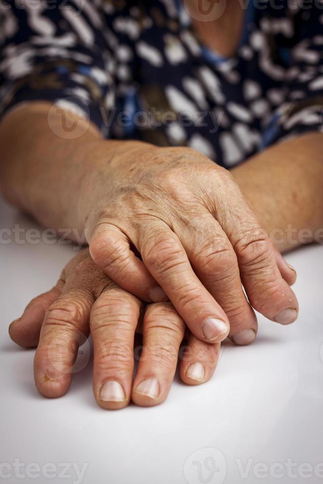 mani di donna deformate dall'artrite reumatoide foto
