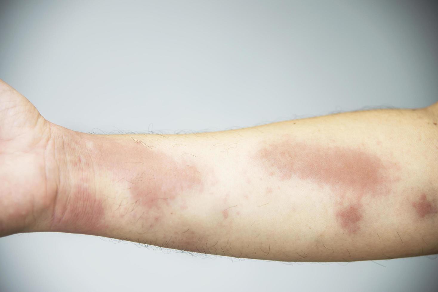uomo che ottiene un'eruzione cutanea rossa nella sua parte del corpo - persone con problemi di allergia cutanea concetto foto