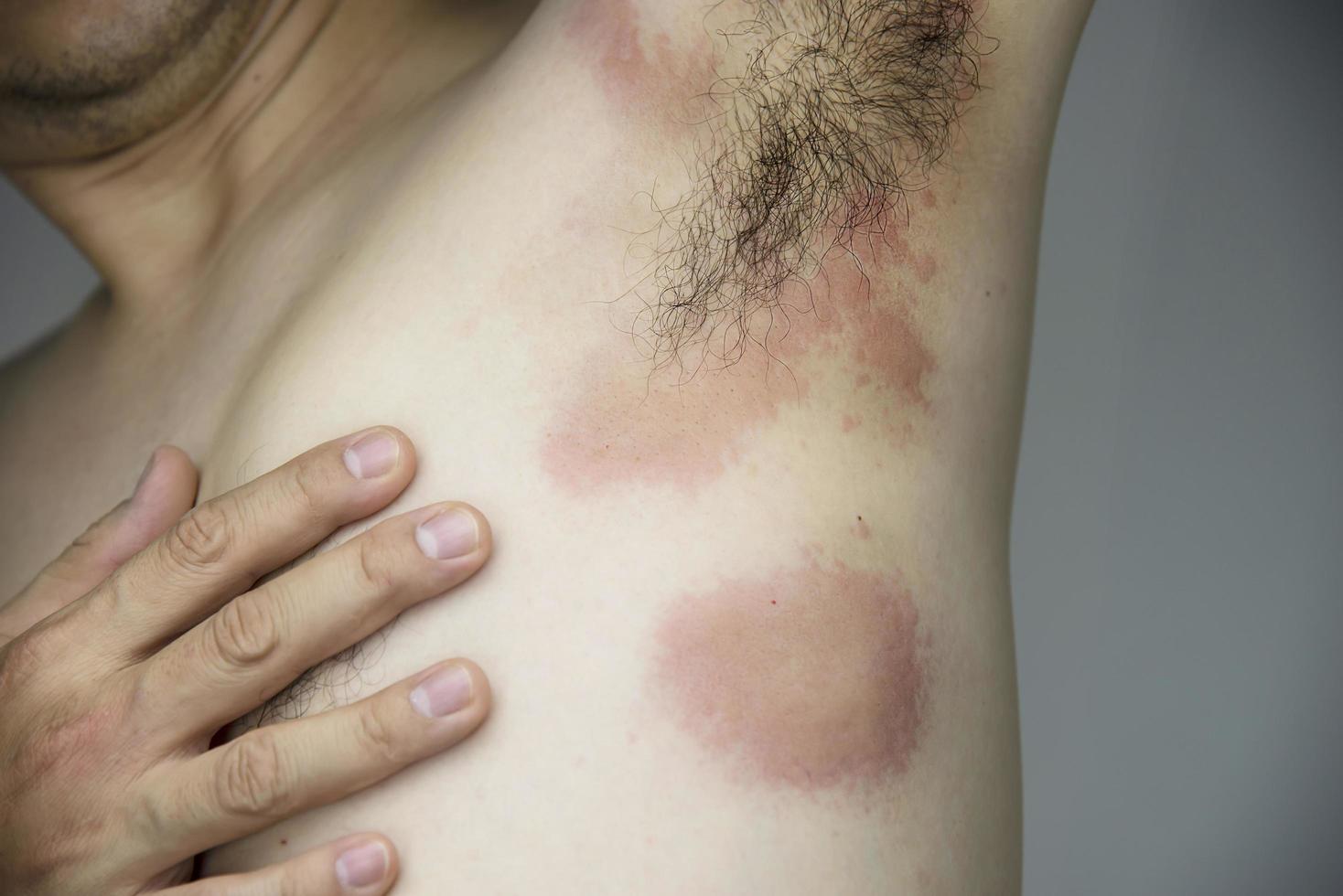 uomo che ottiene un'eruzione cutanea rossa nella sua parte del corpo - persone con problemi di allergia cutanea concetto foto