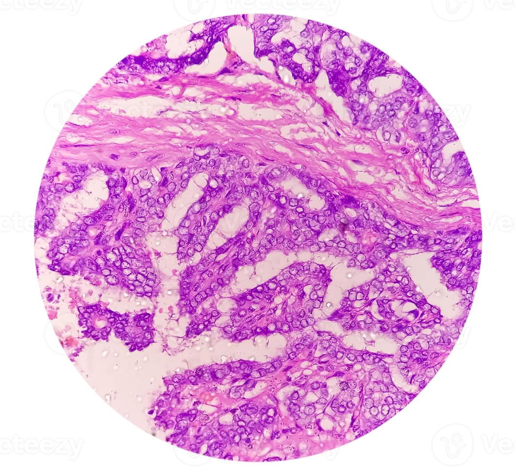 carcinoma tiroideo, immagine al microscopio di carcinoma papillare metastatico della tiroide, linfonodo centrale. foto