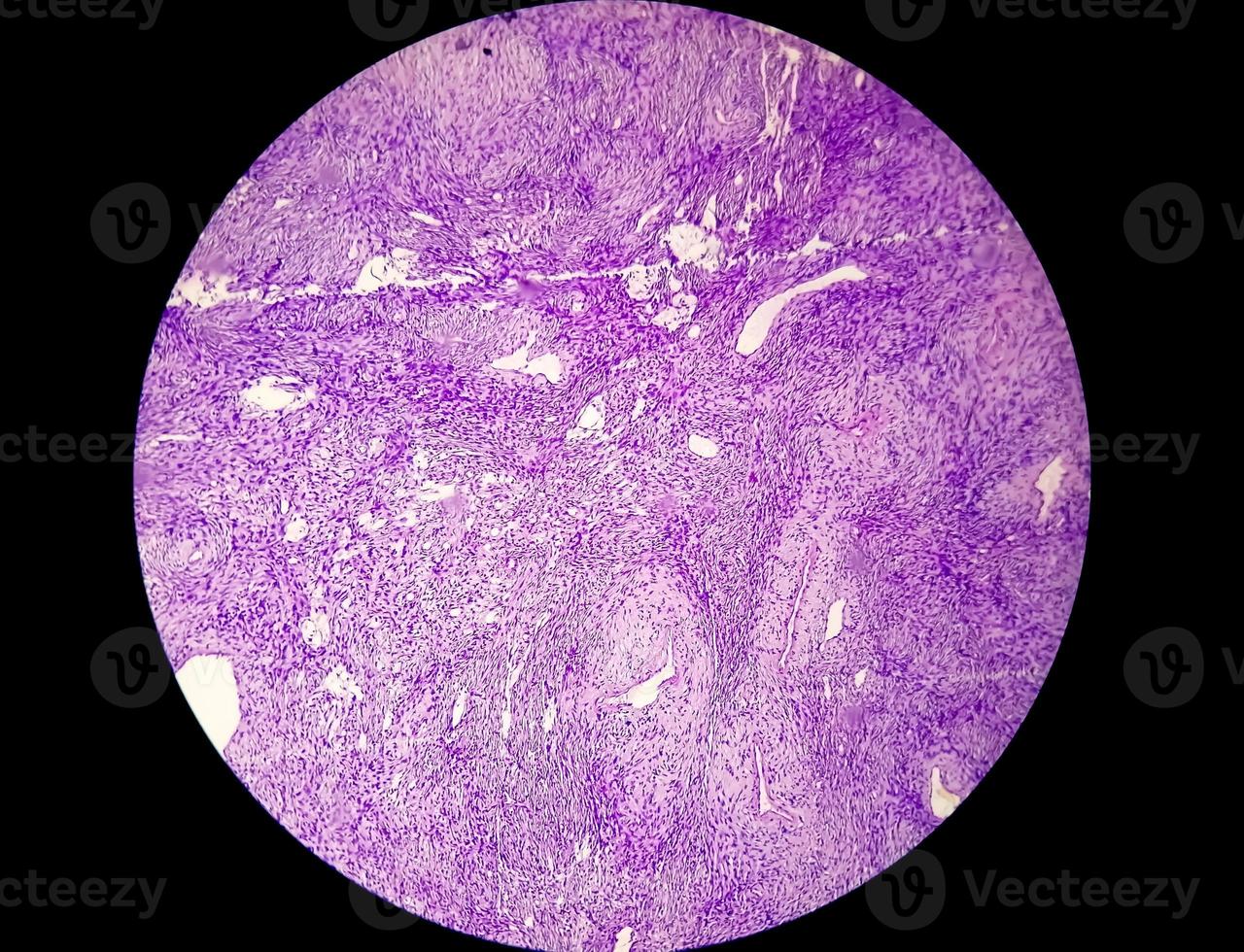 microfotografia o immagine al microscopio del cancro allo stomaco. adenocarcinoma dello stomaco foto