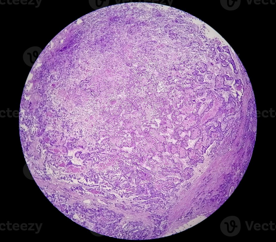 microfotografia o immagine al microscopio del cancro allo stomaco. adenocarcinoma dello stomaco foto