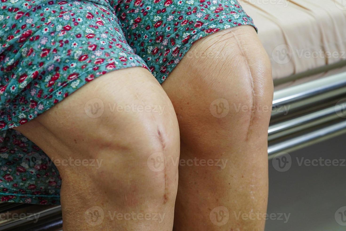 paziente donna anziana asiatica con intervento chirurgico di sostituzione del ginocchio cicatriziale in ospedale. foto