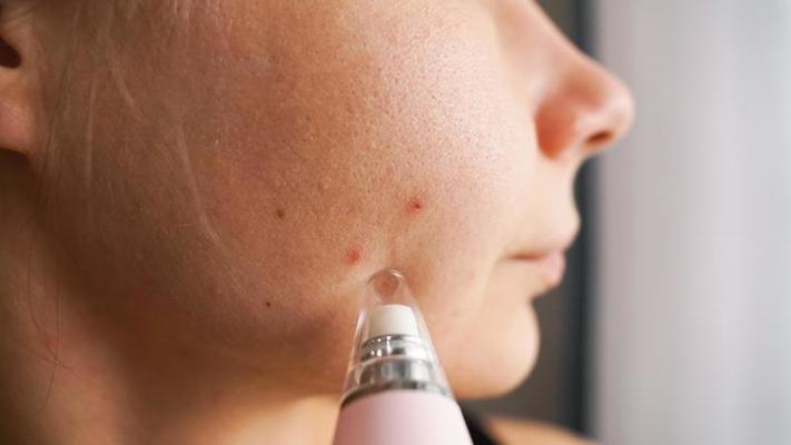 dispositivo di aspirazione per rimuovere punti neri e acne dal viso 5479095  Stock Photo su Vecteezy