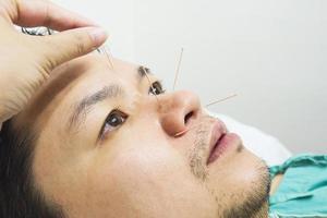 foto in stile vintage di un uomo asiatico concentrato e selettivo sta ricevendo un trattamento di agopuntura