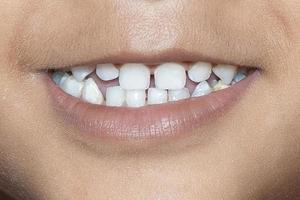 bambino sorriso vicino. denti bianchi di un bambino isolato foto