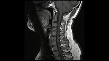 immagini di risonanza magnetica della colonna vertebrale cervicale immagini pesate in t1 sagittale, colonna vertebrale cervicale RM, che mostrano una lieve malattia del disco. foto