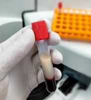 scienziato o biochimico hold test tubo con lipemico sangue campione. alto trigliceridi contenere sangue campione. lipidico profilo. foto