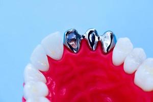 dente impiantare e corona installazione processi foto