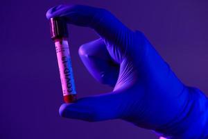 coronavirus, medico Tenere positivo covid-19 virus sangue campione test tubo foto