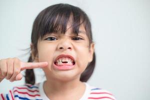 poco asiatico ragazza mostrando sua rotto latte denti. foto