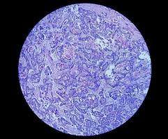 microfotografia o immagine al microscopio del cancro allo stomaco. adenocarcinoma dello stomaco foto