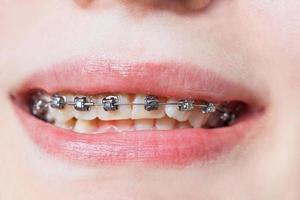 davanti Visualizza di dentale bretelle su denti di superiore mascella foto