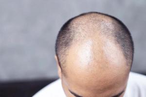 Calvo uomo con capelli i problemi foto