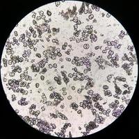 microscopico Immagine mostrando calcio ossalato monoidrato, urico acido cristalli e triplicare fosfato cristalli a partire dal urina sedimento. uti. rene patologia. foto