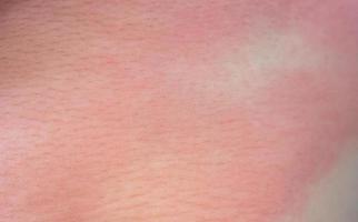 acuto eczema pelle eruzione cutanea e allergico reazione sintomo a poco asiatico bambino corpo causa di ipersensibilità foto