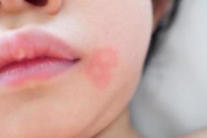 poco asiatico ragazza pelle eruzione cutanea e allergia con rosso individuare causa di zanzara mordere a viso foto